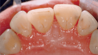 Caries after GBT treatment