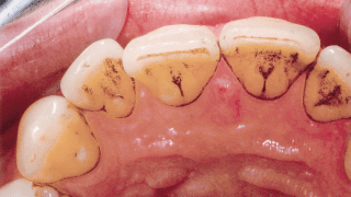 Caries before GBT treatment