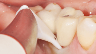 mucositis perioflow 16 x 9	