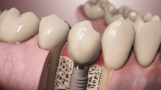 implant europerio