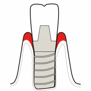 TREAT MUCOSITIS