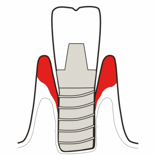 TREAT PERI IMPLANTITIS