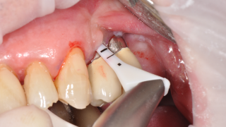 PERI-IMPLANTITIS with perioflow 16 x 9