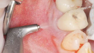 implant maintenance with airflow 16 x9	