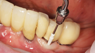 implant maintenance PI tip 16 x 9	