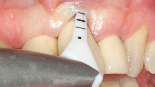 implant maintenance with perioflow 16 x 9