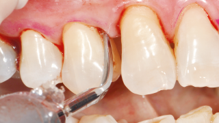 subgingival calculus 16 x 9	