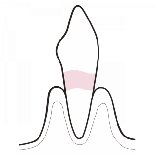 TREAT EXPOSED DENTINE