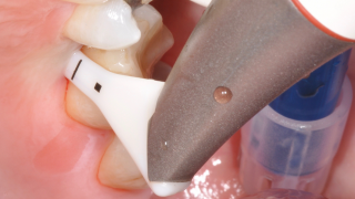 RESIDUAL POCKETS / DEEP TRANS MUCOSAL PORTION