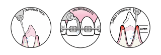 ems