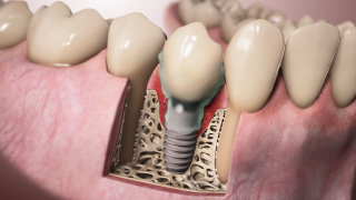 implant 3D