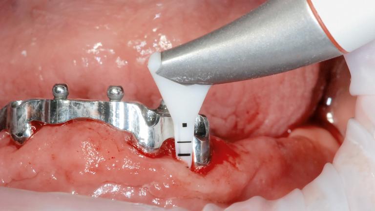 GBT on Implants